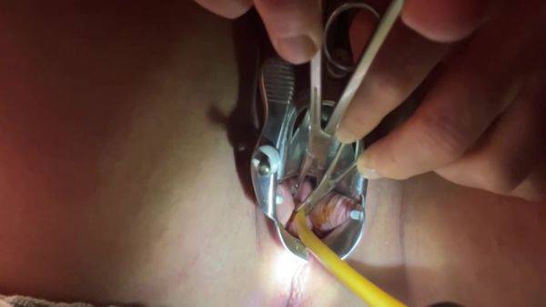 Tenaculum Grasping Cervix For Catheter 7 Min - hclips.com on freevids.org